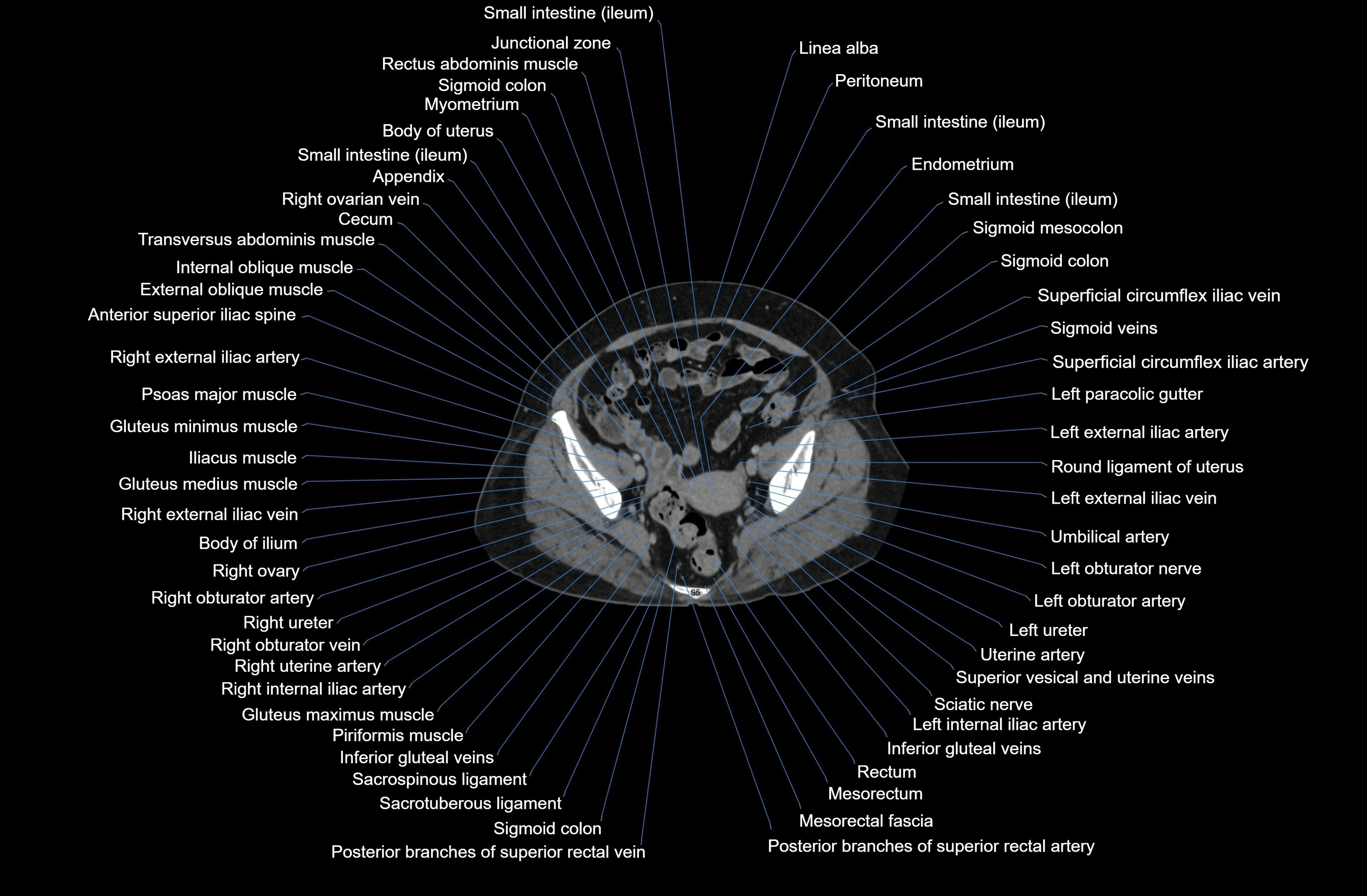 CT Abdomen axial cross sectional anatomy labelled radiology image-00080.webp